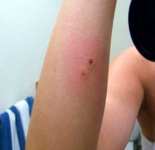 Τσίμπημα σκορπιού στο χέρι